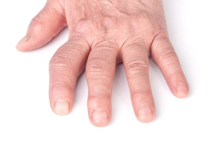 deformująca artroza rąk