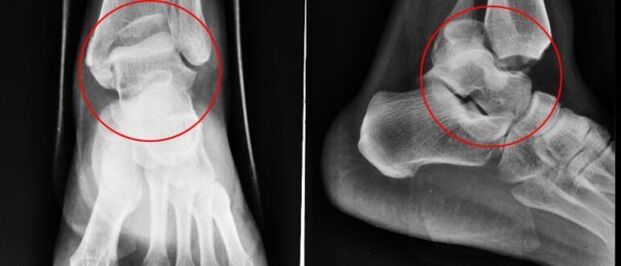 radiografia w przypadku artrozy stawu skokowego