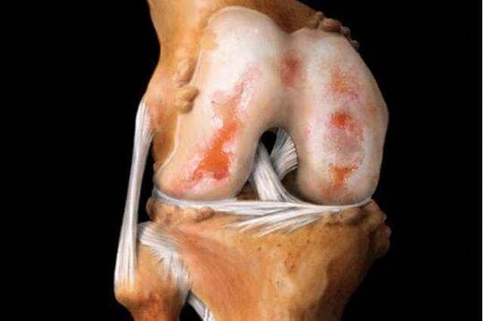 uszkodzenie stawu kolanowego z artrozą