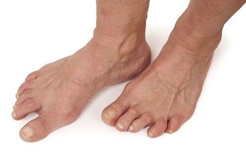 stopy dotknięte artrozą