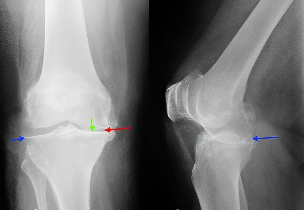 prześwietlenie artrozy stawu kolanowego