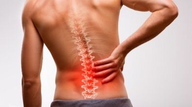 Oznaki i objawy osteochondrozy kręgosłupa lędźwiowego