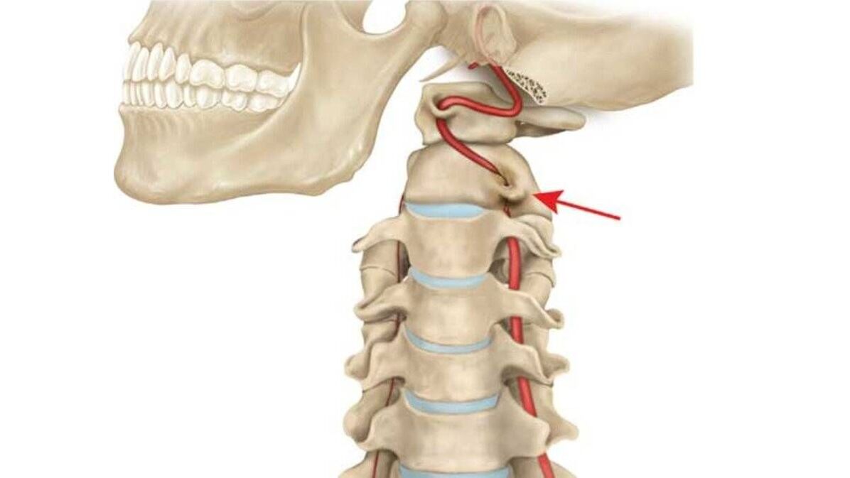 osteochondroza odcinka szyjnego kręgosłupa