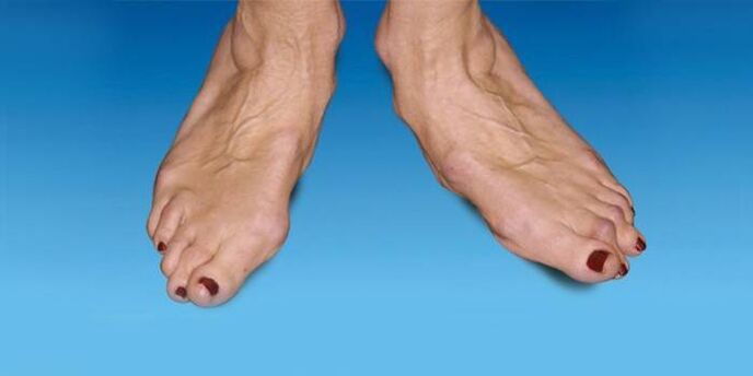 deformacja stopy z artrozą stawu skokowego